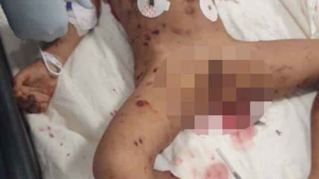 Sokak köpeklerinin saldırısına uğrayan çocuk ağır yaralandı (2)- Yeniden