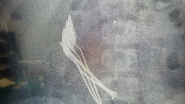 15 yaşındaki çocuğun midesinden 4 kaşık ve 1 çivi çıkarıldı