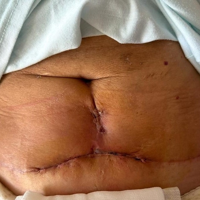 Kol ve karın germe ameliyatı oldu, dikiş izleri kaldı