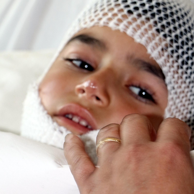 Nahçıvan'da pilav kazanına düştü, Erzurum'da tedavi görüyor