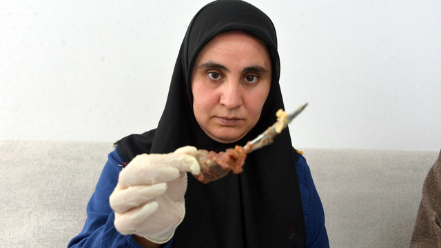 Ameliyatta karnında unutulan makas, 7 yıl sonra baş ağrısıyla ortaya çıktı