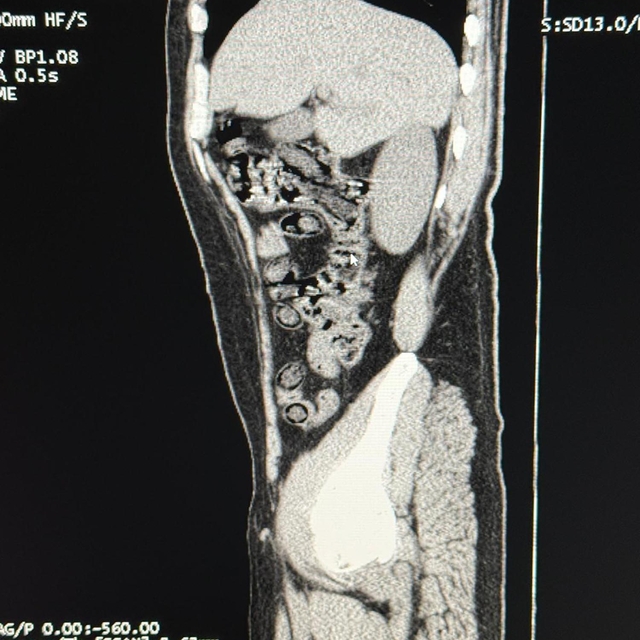 İran uyruklu 2 şüphelinin medelerinden 94 kapsül halinde metamfetamin çıkar...