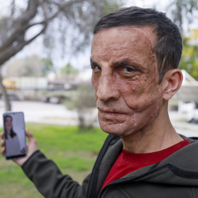 Babasının yüzünün nakledildiği Uğur'la duygulandıran görüşme