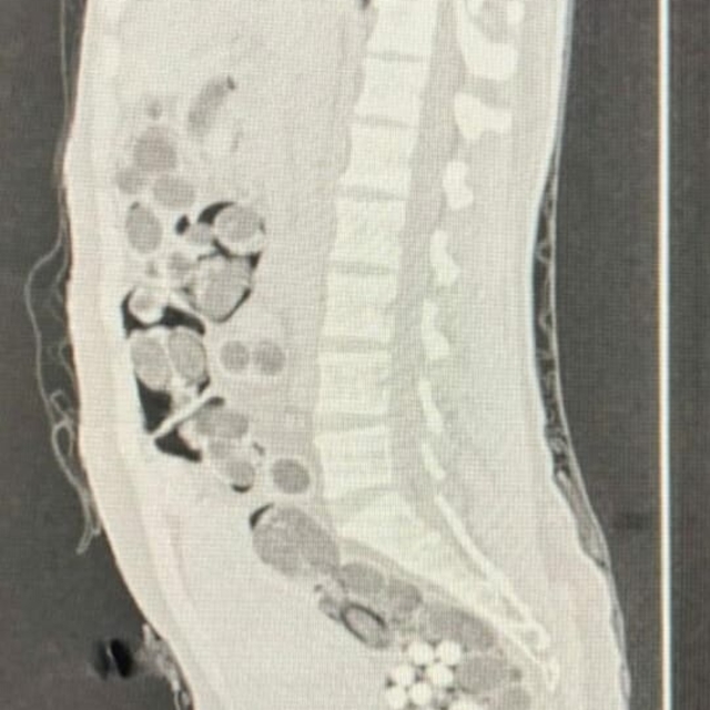 Yabancı uyruklu yolcunun midesinden 219 paket uyuşturucu çıktı