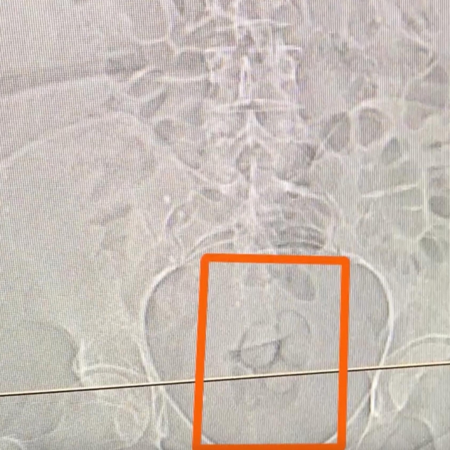 Midesinden 21,39 gram metamfetamin çıktı
