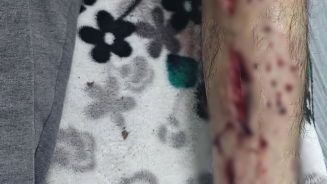 Sokak köpeğinin saldırısına uğradı, bacağına 25 dikiş atıldı