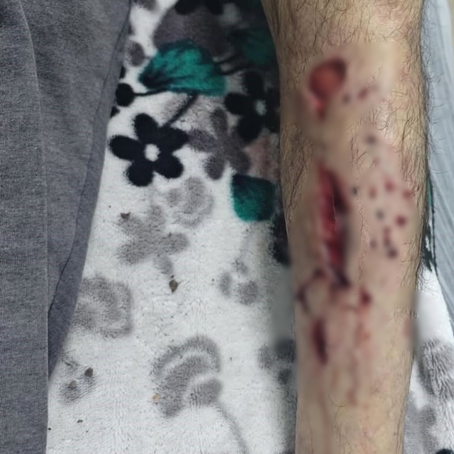 Sokak köpeğinin saldırısına uğradı, bacağına 25 dikiş atıldı