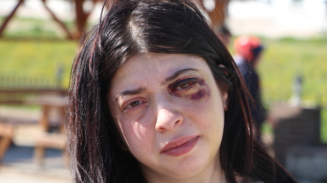 Sokak ortasında darbedilen Damla: 3 ay sıvı ile besleneceğim