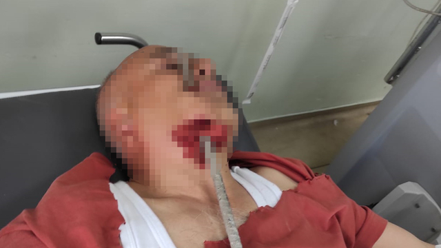 Şantiyede ayağı kayıp düşen işçinin yüzüne inşaat demiri saplandı