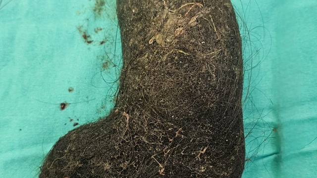 9 yaşındaki çocuğun midesinden saç yumağı çıktı