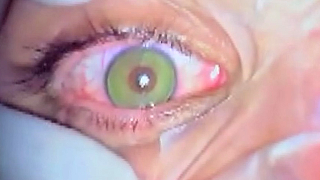 Göz rengini kalıcı olarak değiştirmek mümkün; en çok mavi ve yeşil uygulanıyor