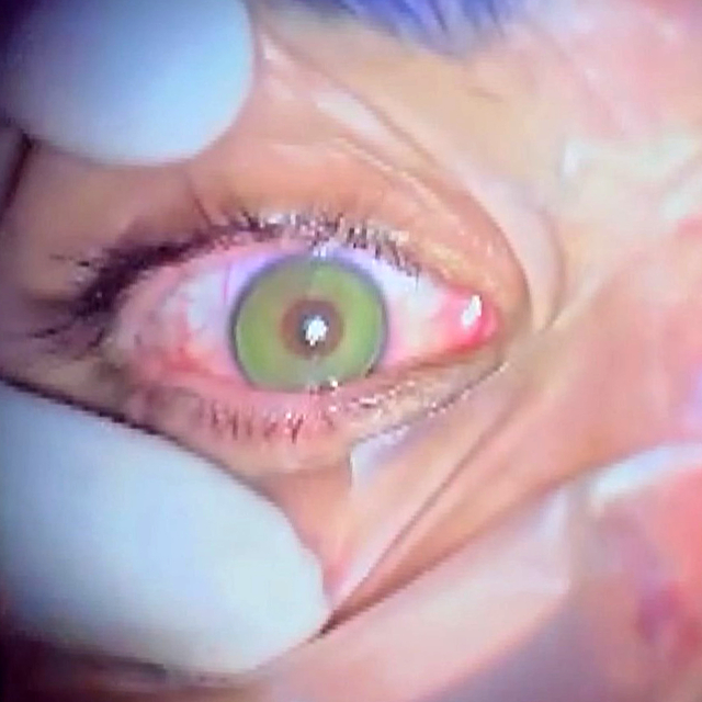 Göz rengini kalıcı olarak değiştirmek mümkün; en çok mavi ve yeşil uygulanı...