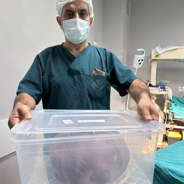 Yumurtalıklarındaki 9 kiloluk kitle operasyonla çıkarıldı