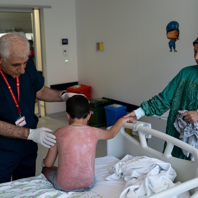 Güneşte 4 saat kalan çocuk, ikinci derece yanıkla hastanelik oldu