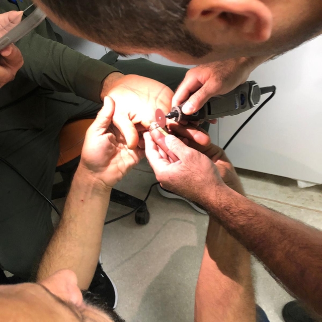 Mardin'de parmakta sıkışan yüzük itfaiye ekibince hastanede çıkarıldı