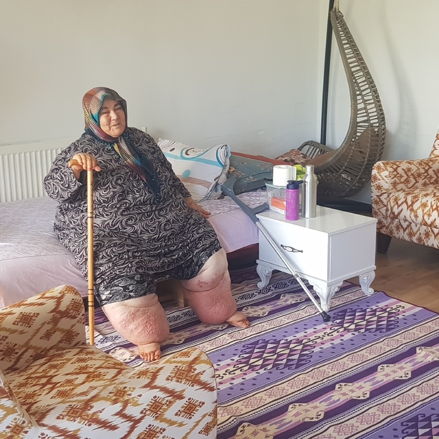 Osmaniye'de yaşayan 160 kilogram ağırlığındaki "fil hastası" Güler'e tekerl...