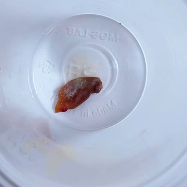 1,5 yıllık öksürüğün nedeni, kabak çekirdeği çıktı