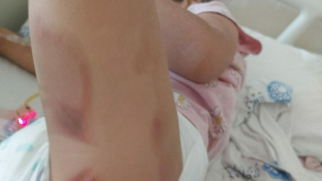 3 yaşındaki Yaren ameliyattan yanık izleriyle çıktı, aile suç duyurusunda bulundu