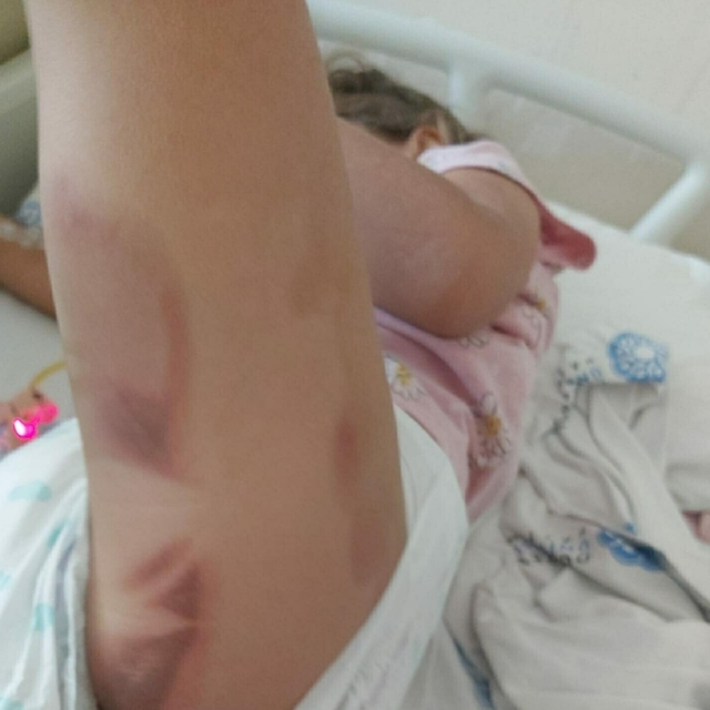 3 yaşındaki Yaren ameliyattan yanık izleriyle çıktı, aile suç duyurusunda b...