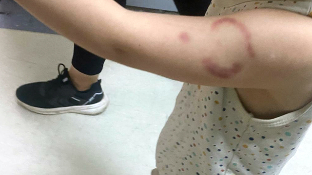 Bakımevinde 3 yaşındaki öğrencisinin kolunu ısıran öğretmen tutuklandı