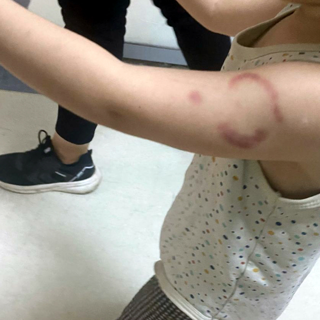 Bakımevinde 3 yaşındaki öğrencisinin kolunu ısıran öğretmen tutuklandı