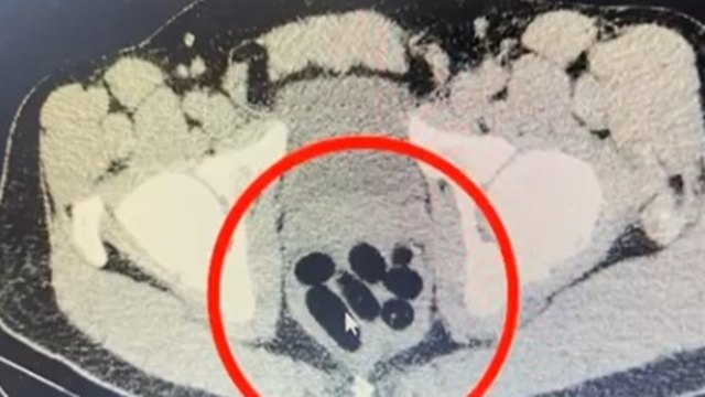 Midesinden yarım kilo metamfetamin çıktı