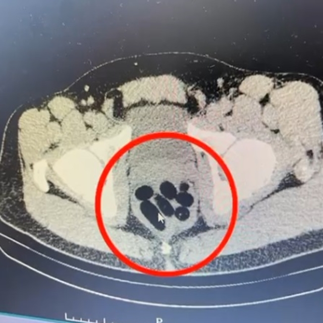 Midesinden yarım kilo metamfetamin çıktı