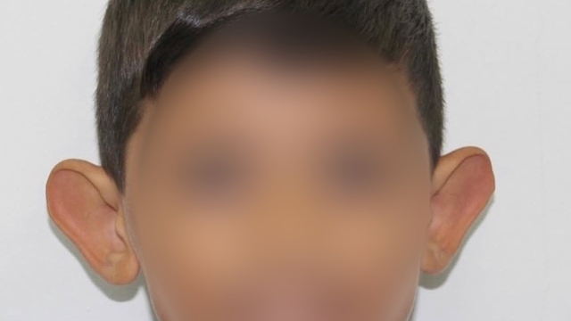 'Kepçe kulak' sorunu çocuklarda özgüveni zedeliyor
Prof. Dr. Hayati Akbaş: "Tedavi okul öncesi dönemde mutlaka yapılmalı"