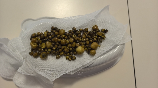 Bursa'da 77 yaşındaki kadının safra kesesinden 213 tane taş çıkarıldı