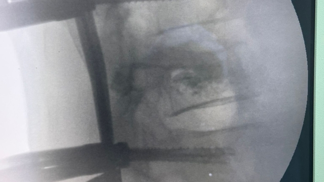 Trabzon'da omurga vidalama ameliyatı geçiren hasta sağlığına kavuştu