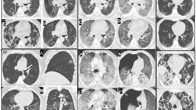 Gençlerde ani ölümler artıyor: "Nedeni ise virüsün damarlarda bıraktığı hasar"