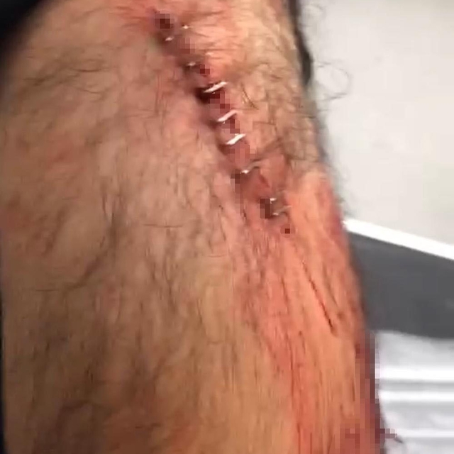 Şanlıurfa'da görev yapan öğretmene sokak ortasında jiletli saldırı