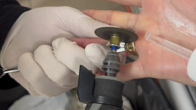 Batman'da parmağa sıkışan iki yüzük 'spiral makine' ile çıkarıldı