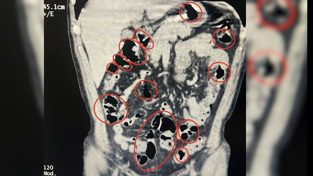 Yabancı uyruklu 2 kişinin mide ve bağırsaklarından uyuşturucu çıktı
