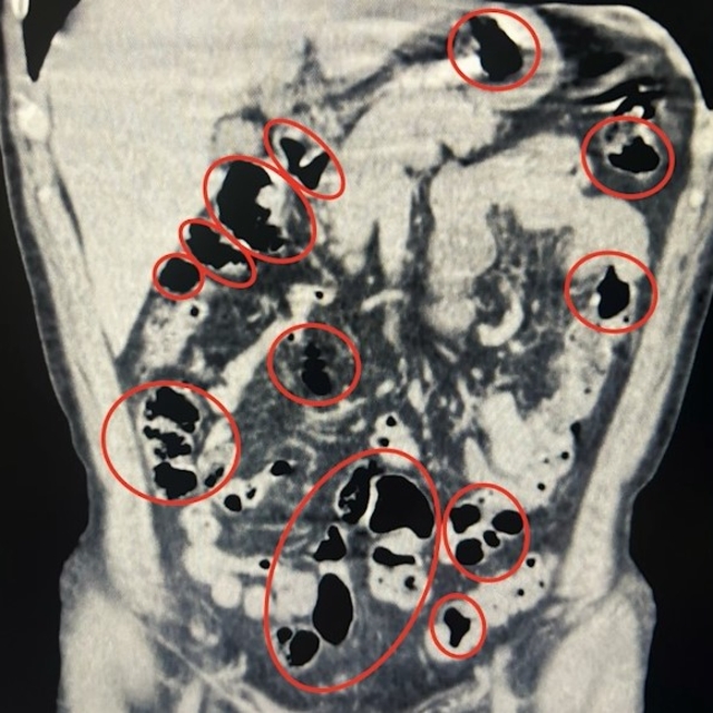 Yabancı uyruklu 2 kişinin mide ve bağırsaklarından uyuşturucu çıktı