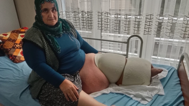 35 yıldır fil hastalığıyla mücadele ediyor