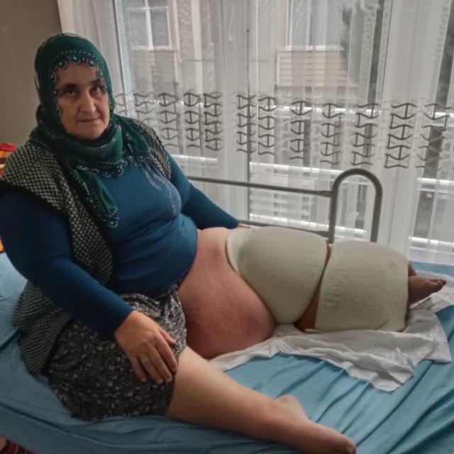 35 yıldır fil hastalığıyla mücadele ediyor