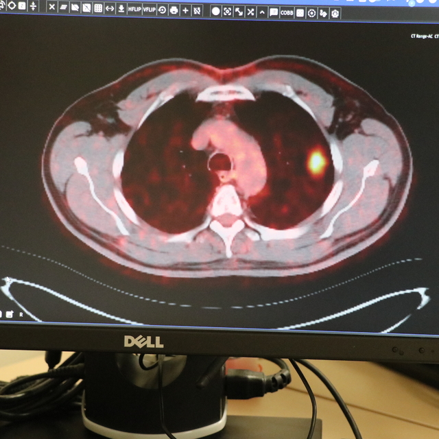 Akciğer kanserini yenen 50 yıllık sigara tiryakisi: 2 aydır adını anmıyorum