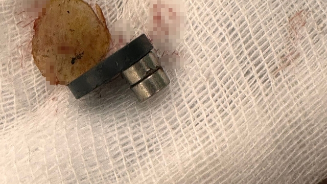 Bebeğin yuttuğu mıknatıslar bağırsak delinmesine neden oldu