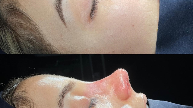 Cizre'de ilk defa yapılan revizyon rinoplasti ameliyatı gerçekleştirildi