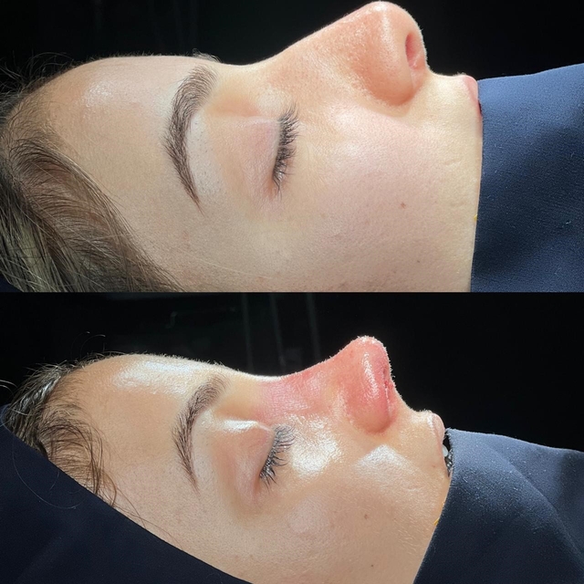 Cizre'de ilk defa yapılan revizyon rinoplasti ameliyatı gerçekleştirildi