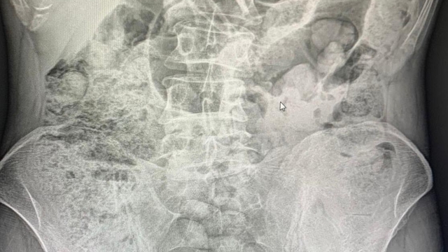 Siirt'te midelerinden uyuşturucu çıkan 4 şahıs tutuklandı