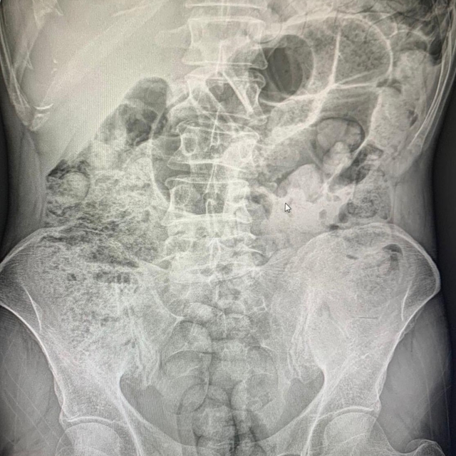 Siirt'te midelerinden uyuşturucu çıkan 4 şahıs tutuklandı