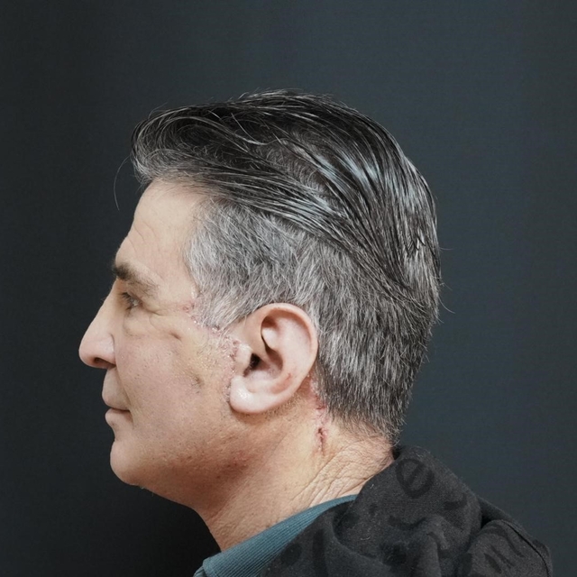 Bitlis'te ilk defa yüz germe ameliyatı başarıyla yapıldı