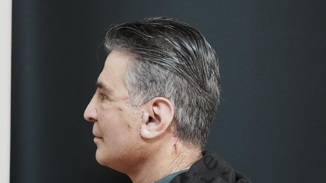 Bitlis'te ilk defa yüz germe ameliyatı başarıyla yapıldı