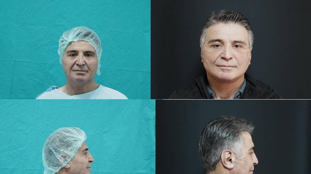 Bitlis'te ilk kez "derin plan yüz germe ameliyatı" yapıldı