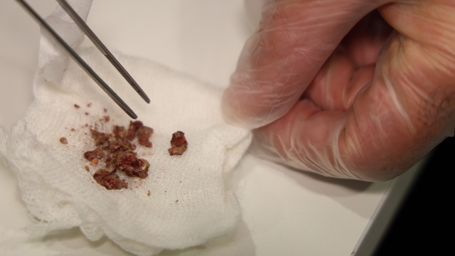 Elazığ'da estetik ameliyatta şaşırtan olay, burundan taş çıktı
Estetik hayaliyle girdiği ameliyatta burnunda taş bulundu
Genelde safra kesesinde görülen taş, bu kez burunda çıktı