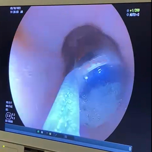 Midesindeki 9 pil, endoskopik yöntemle çıkarıldı