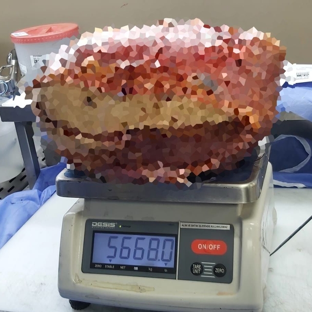 Diyarbakır'da, hastanın bacağından 5 kilo 668 gramlık kitle çıkarıldı