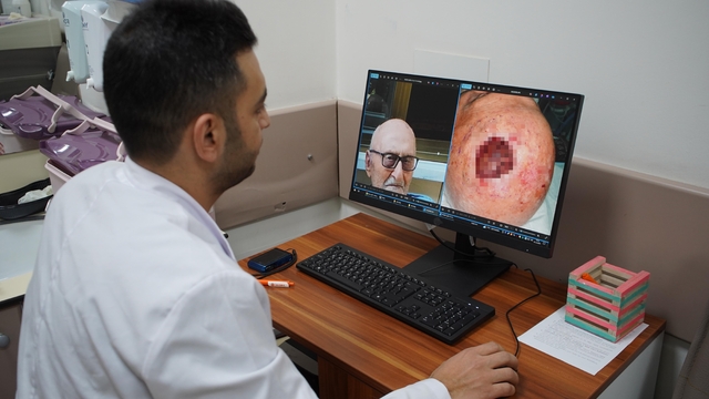 Dünyada 3'üncü kez rastlandı: Saçlı derideki nadir tümör Sakarya'da tedavi edildi
Op. Dr. Muaz Zuhurlu: "Dünyada sadece iki vakada rastlanmıştır, bizim vakamız da üçüncü olarak bildirilmiş olacak"
Tıbbi Patoloji Kliniği Klinik İdari Sorumlusu Prof. Dr. Fahri Yılmaz:
"Alıştığımızın dışında bir tümör gördük"
